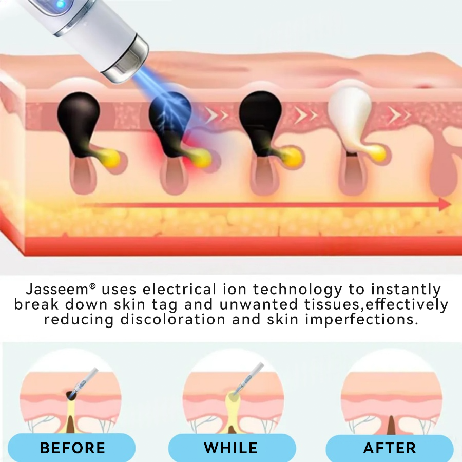 𝐉𝐚𝐬𝐬𝐞𝐞𝐦® Medical-Grade Laser Pen 🌏 (Powered by CO₂ laser technology – effectively removes moles, warts, skin tags, pigmentation spots, and other skin imperfections)
