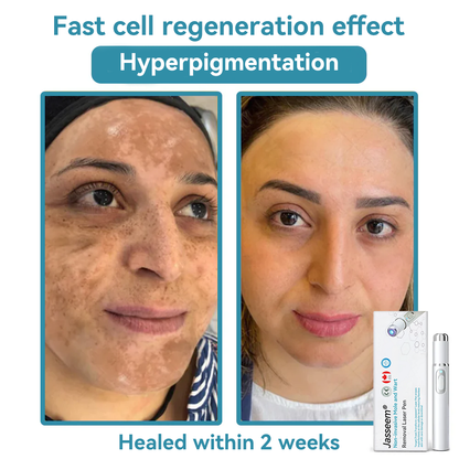 𝐉𝐚𝐬𝐬𝐞𝐞𝐦® Medical-Grade Laser Pen 🌏 (Powered by CO₂ laser technology – effectively removes moles, warts, skin tags, pigmentation spots, and other skin imperfections)