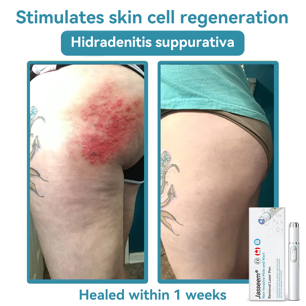 𝐉𝐚𝐬𝐬𝐞𝐞𝐦® Medical-Grade Laser Pen 🌏 (Powered by CO₂ laser technology – effectively removes moles, warts, skin tags, pigmentation spots, and other skin imperfections)