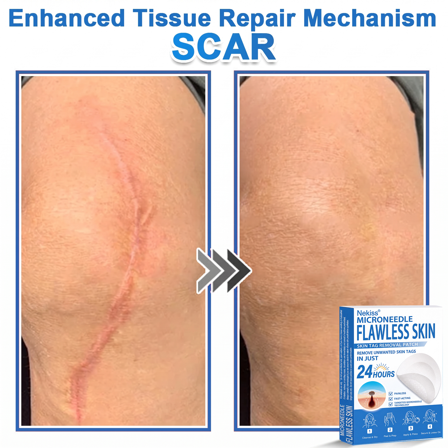 👩‍⚕️🎁 𝐎𝐟𝐟𝐢𝐜𝐢𝐚𝐥 𝐒𝐭𝐨𝐫𝐞 | 𝑵𝐞𝒌𝐢𝐬𝐬® 🌿 𝐁𝐨𝐭𝐚𝐧𝐢𝐜𝐚𝐥 𝐌𝐢𝐜𝐫𝐨𝐧𝐞𝐞𝐝𝐥𝐞 𝐇𝐲𝐝𝐫𝐨𝐜𝐨𝐥𝐥𝐨𝐢𝐝 𝐏𝐚𝐭𝐜𝐡 (𝐅𝐨𝐫 𝐒𝐤𝐢𝐧 𝐓𝐚𝐠𝐬, 𝐒𝐦𝐚𝐥𝐥 𝐒𝐤𝐢𝐧 𝐆𝐫𝐨𝐰𝐭𝐡𝐬, 𝐖𝐚𝐫𝐭𝐬, 𝐌𝐨𝐥𝐞𝐬, 𝐀𝐠𝐞 𝐒𝐩𝐨𝐭𝐬 & 𝐏𝐢𝐠𝐦𝐞𝐧𝐭𝐚𝐭𝐢𝐨𝐧 𝐂𝐨𝐧𝐜𝐞𝐫𝐧𝐬)