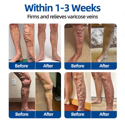 👩‍⚕️🎁 𝐅𝐥𝐨𝐫𝐢𝐬𝐦𝐚®✅𝐕𝐞𝐢𝐧𝐓𝐚𝐫𝐠𝐞𝐭 𝐌𝐢𝐜𝐫𝐨𝐧𝐞𝐞𝐝𝐥𝐞 𝐏𝐚𝐭𝐜𝐡⚡Instant Relief, Long-Term Results