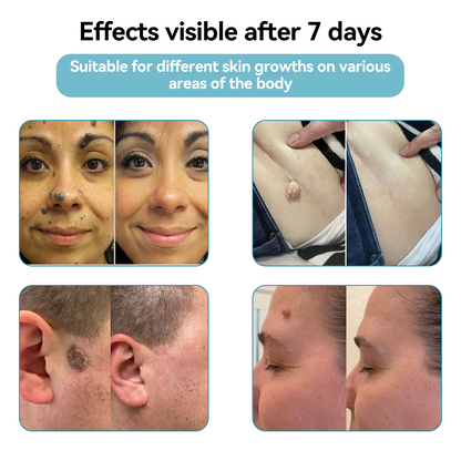 𝐉𝐚𝐬𝐬𝐞𝐞𝐦® Medical-Grade Laser Pen 🌏 (Powered by CO₂ laser technology – effectively removes moles, warts, skin tags, pigmentation spots, and other skin imperfections)