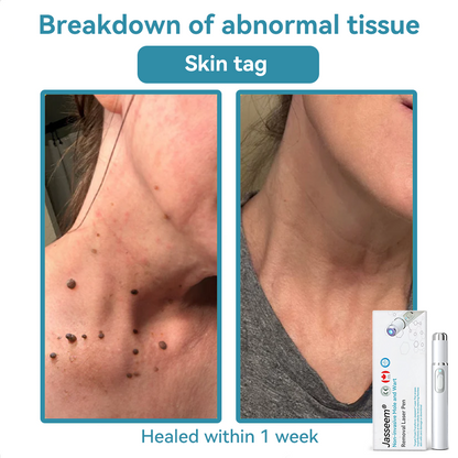 𝐉𝐚𝐬𝐬𝐞𝐞𝐦® Medical-Grade Laser Pen 🌏 (Powered by CO₂ laser technology – effectively removes moles, warts, skin tags, pigmentation spots, and other skin imperfections)