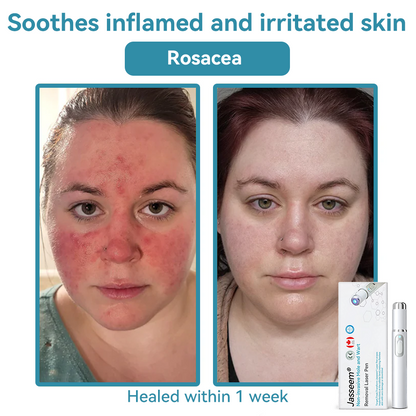 𝐉𝐚𝐬𝐬𝐞𝐞𝐦® Medical-Grade Laser Pen 🌏 (Powered by CO₂ laser technology – effectively removes moles, warts, skin tags, pigmentation spots, and other skin imperfections)