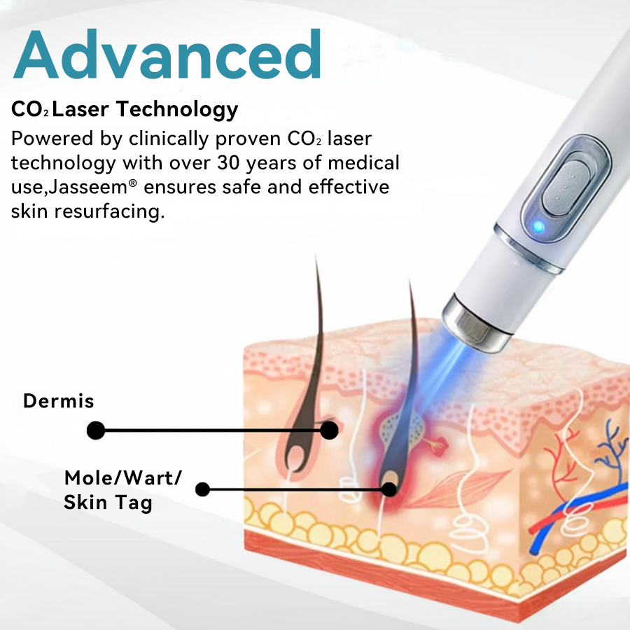 𝐉𝐚𝐬𝐬𝐞𝐞𝐦® Medical-Grade Laser Pen 🌏 (Powered by CO₂ laser technology – effectively removes moles, warts, skin tags, pigmentation spots, and other skin imperfections)
