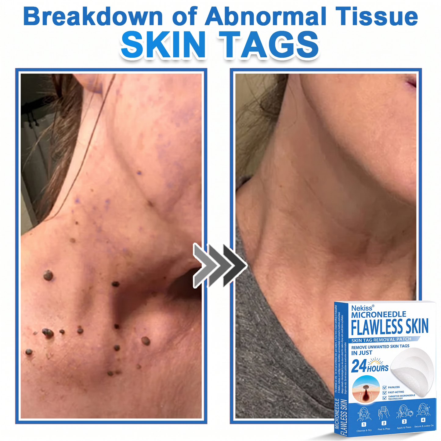 👩‍⚕️🎁 𝐎𝐟𝐟𝐢𝐜𝐢𝐚𝐥 𝐒𝐭𝐨𝐫𝐞 | 𝑵𝐞𝒌𝐢𝐬𝐬® 🌿 𝐁𝐨𝐭𝐚𝐧𝐢𝐜𝐚𝐥 𝐌𝐢𝐜𝐫𝐨𝐧𝐞𝐞𝐝𝐥𝐞 𝐇𝐲𝐝𝐫𝐨𝐜𝐨𝐥𝐥𝐨𝐢𝐝 𝐏𝐚𝐭𝐜𝐡 (𝐅𝐨𝐫 𝐒𝐤𝐢𝐧 𝐓𝐚𝐠𝐬, 𝐒𝐦𝐚𝐥𝐥 𝐒𝐤𝐢𝐧 𝐆𝐫𝐨𝐰𝐭𝐡𝐬, 𝐖𝐚𝐫𝐭𝐬, 𝐌𝐨𝐥𝐞𝐬, 𝐀𝐠𝐞 𝐒𝐩𝐨𝐭𝐬 & 𝐏𝐢𝐠𝐦𝐞𝐧𝐭𝐚𝐭𝐢𝐨𝐧 𝐂𝐨𝐧𝐜𝐞𝐫𝐧𝐬)