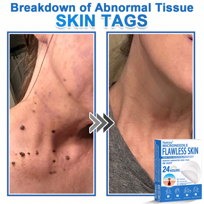 👩‍⚕️🎁 𝐎𝐟𝐟𝐢𝐜𝐢𝐚𝐥 𝐒𝐭𝐨𝐫𝐞 | 𝑵𝐞𝒌𝐢𝐬𝐬® 🌿 𝐁𝐨𝐭𝐚𝐧𝐢𝐜𝐚𝐥 𝐌𝐢𝐜𝐫𝐨𝐧𝐞𝐞𝐝𝐥𝐞 𝐇𝐲𝐝𝐫𝐨𝐜𝐨𝐥𝐥𝐨𝐢𝐝 𝐏𝐚𝐭𝐜𝐡 (𝐅𝐨𝐫 𝐒𝐤𝐢𝐧 𝐓𝐚𝐠𝐬, 𝐒𝐦𝐚𝐥𝐥 𝐒𝐤𝐢𝐧 𝐆𝐫𝐨𝐰𝐭𝐡𝐬, 𝐖𝐚𝐫𝐭𝐬, 𝐌𝐨𝐥𝐞𝐬, 𝐀𝐠𝐞 𝐒𝐩𝐨𝐭𝐬 & 𝐏𝐢𝐠𝐦𝐞𝐧𝐭𝐚𝐭𝐢𝐨𝐧 𝐂𝐨𝐧𝐜𝐞𝐫𝐧𝐬)